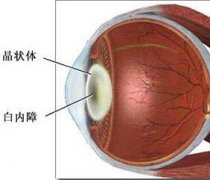 儿童眼外伤易并发白内障 越早治疗越好