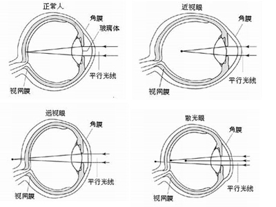 近视眼怎么恢复视力_郑州博爱眼耳鼻喉医院